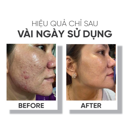 Bộ sản phẩm chăm sóc da LÁ HOUSE gồm Toner giúp ngăn ngừa mụn Acne Control,Bông tẩy trang