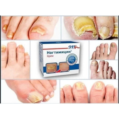Kem Nấm móng NOGTIMITSIN Before and After Nga loại bỏ móng hỏng, thối móng