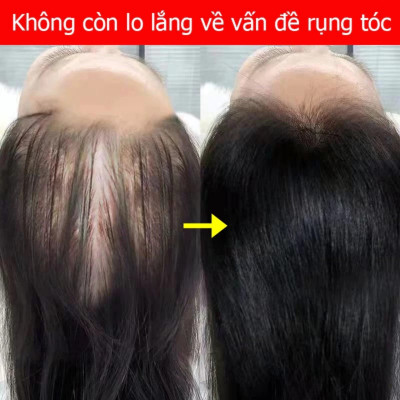 Tinh Dầu Xịt Mọc Tóc EELHOE: Tinh Chất Nhân Sâm và Gừng Tươi Thiên Nhiên Kích Thích Mọc Tóc Sau 7 Ngày Loại Tốt