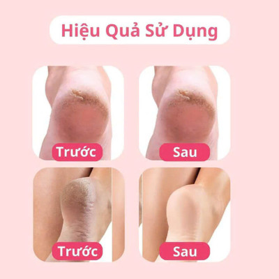 Máy Chà Gót Chân Sạc Điện Tốt Nhất Hiện Nay - An Toàn, Không Đau Rát