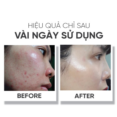 Serum giúp dưỡng trắng da, làm mờ sẹo và se khít lỗ chân lông Lá House Scars Therapy Concentrated 15ml/30ml