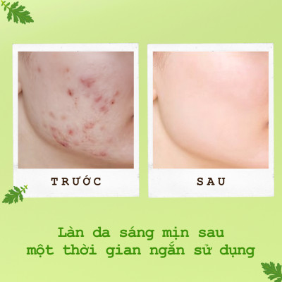 Mặt Nạ Ngủ Ngải Cứu Ngừa Mụn Sáng Da POP