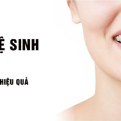 Cho máy Oral B, răng niềng, Set bộ 4 đầu bàn chải đánh răng điện New IP-17A cho răng niềng Minh House-Hàng chính hãng