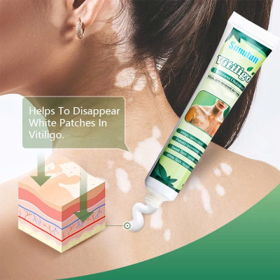 [Vilitigo] Kem Bôi Hắc Lào, Nấm Ngứa, Á Sừng, Lang Ben, Vẩy Nến - Chiết Xuất Thảo Mộc Tự Nhiên, Loại Tốt